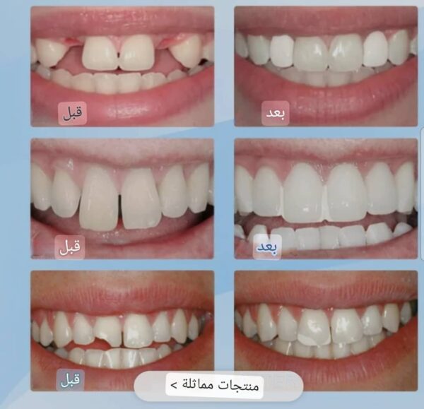 ⁦*مجموعة إصلاح الأسنان الفورية مع 4 قطع طبية آستيل لاستخدام مثالي*⁩ - الصورة ⁦5⁩