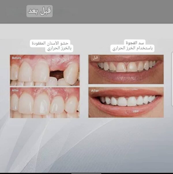 ⁦*مجموعة إصلاح الأسنان الفورية مع 4 قطع طبية آستيل لاستخدام مثالي*⁩ - الصورة ⁦7⁩